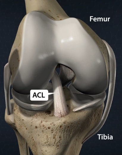 Anterior Cruciate Ligament (ACL) Tear Treatment & Surgery in