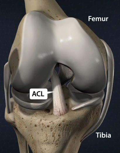 Arthroscopic picture of left knee revealing (a) bulky anterior cruciate