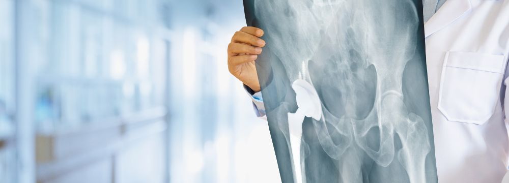 Orthopedic surgeon in southern California examines imaging of a hip replacement for signs of ware